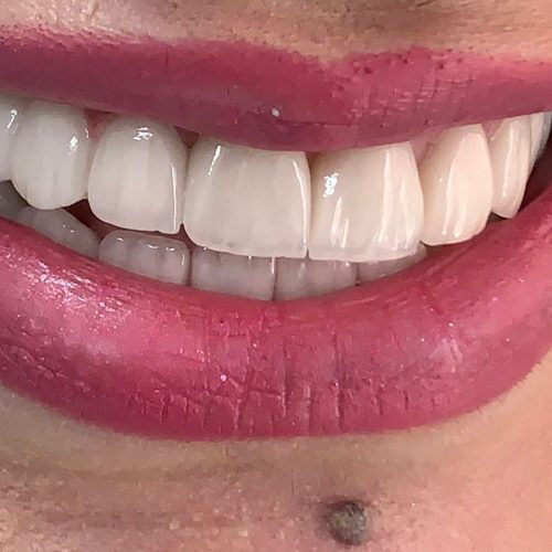 Veneer-BA-1